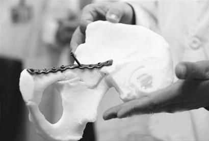 bone fixation surgery 3d