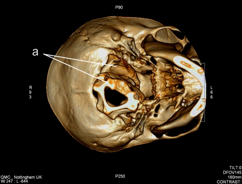 Inestabilidad atlanto axial síndrome de Down