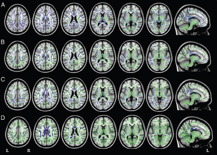 2015_05_26_16_11_16_316_DTI_MRI_Alzhiemers_Radiology