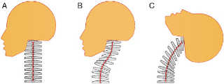Latigazo Cervical
