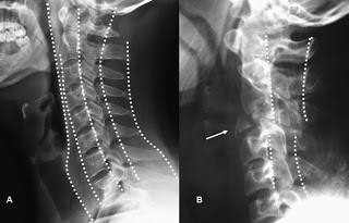 lineas curvatura col cv