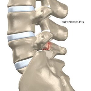 espondilolisis