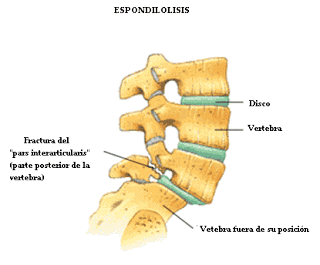 espondilolisis2