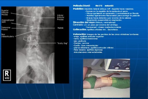 vista-oblicua-columna-lumbar