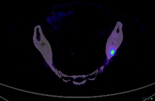 metastatic-prostate-cancer-to-pagetoid-bone-value-of-ga68psma-scan3